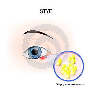 Stye. Human`s Eye and bacteria that cause it