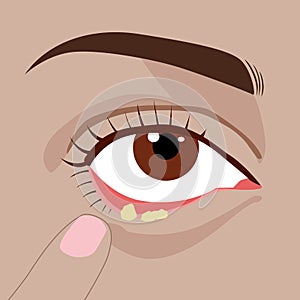 Stye internal eye or hordeolum, bacterial disease infection, illustration