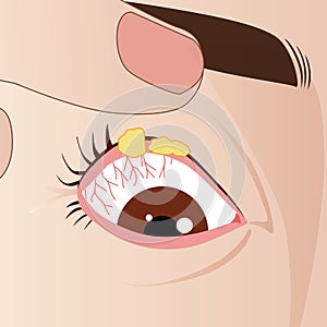 Stye internal eye or hordeolum, bacterial disease infection, illustration