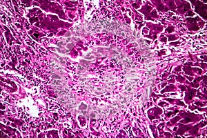 Subacute severe hepatitis, light micrograph