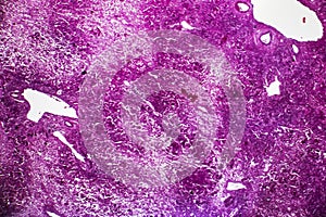 Subacute severe hepatitis, light micrograph