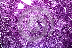 Subacute severe hepatitis, light micrograph