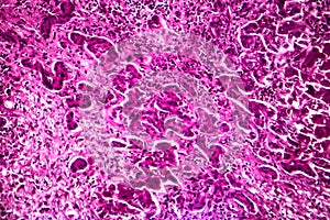 Subacute severe hepatitis, light micrograph