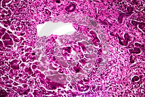 Subacute severe hepatitis, light micrograph