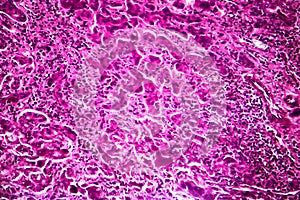 Subacute severe hepatitis, light micrograph