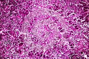 Subacute severe hepatitis, light micrograph
