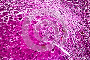 Subacute severe hepatitis, light micrograph