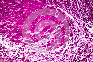 Subacute severe hepatitis, light micrograph