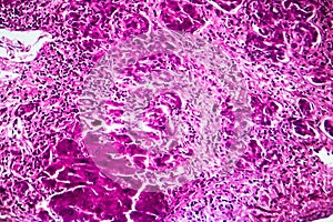 Subacute severe hepatitis, light micrograph