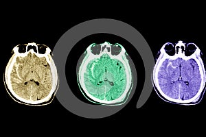 subarachnoid hemorrhage