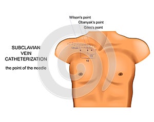 Subclavian vein catheterization. access point