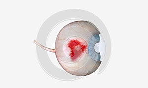 Subconjunctival hemorrhage is a bright red patch appearing in the white of the eye