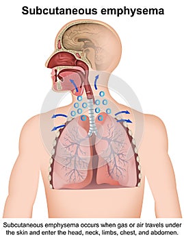 Subcutaneous emphysema medical vector illustration with english description on white background, anatomy infographic