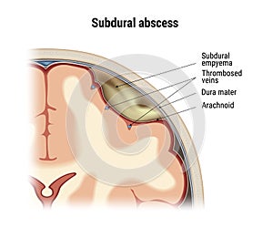 Subdural abscess vector