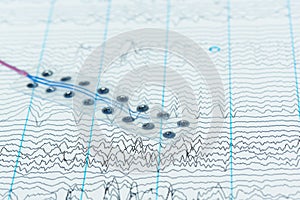 Subdural electrode on background of brain waves