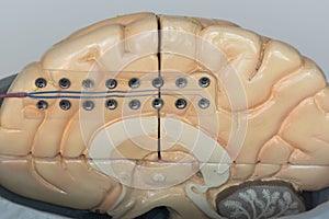 Subdural electrode on medial side of brain hemisphere