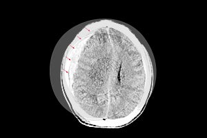 subdural hemorrhage with brain edema