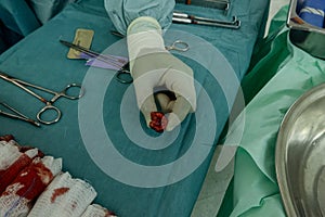 Subglottic Tracheal Stenosis after prolongued tracheal intubation surgery.