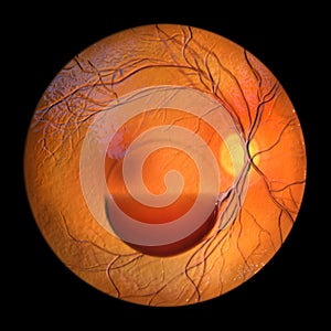 A subhyaloid hemorrhage on the retina as observed during ophthalmoscopy, 3D illustration