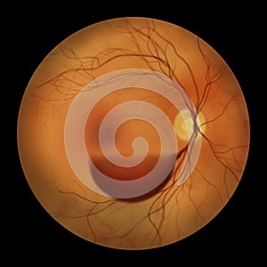A subhyaloid hemorrhage on the retina as observed during ophthalmoscopy, an illustration