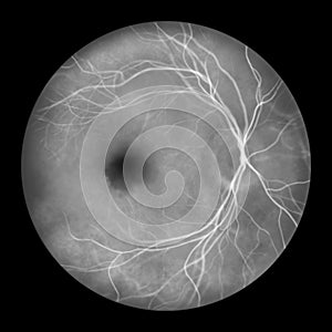 A submacular hemorrhage on the retina, as observed in a fluorescein angiogram, an illustration