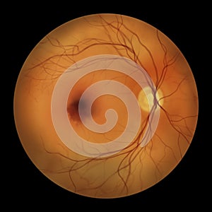 A submacular hemorrhage on the retina as observed during ophthalmoscopy, an illustration