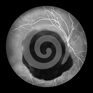 A subretinal hemorrhage as observed during ophthalmoscopy, an illustration