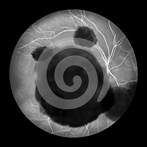 A subretinal hemorrhage as observed during ophthalmoscopy, an illustration