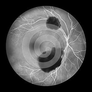 A subretinal hemorrhage as observed during ophthalmoscopy, an illustration