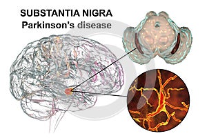 Substantia nigra, a basal banglia of the midbrain, in Parkinson's disease