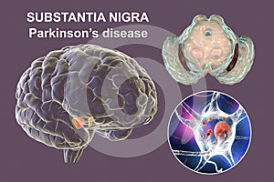 Substantia nigra, a basal banglia of the midbrain, in Parkinson's disease