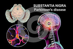 Substantia nigra, a basal banglia of the midbrain, in Parkinson's disease, 3D illustration