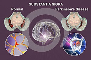 Substantia nigra of the midbrain and its dopaminergic neurons in normal state and in Parkinson's disease, 3D