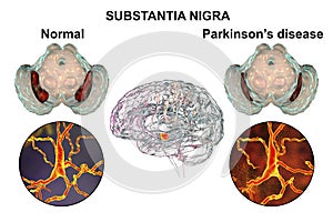 Substantia nigra of the midbrain and its dopaminergic neurons in normal state and in Parkinson's disease, 3D