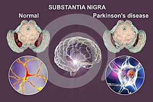 Substantia nigra of the midbrain and its dopaminergic neurons in normal state and in Parkinson's disease, 3D photo
