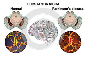 Substantia nigra of the midbrain and its dopaminergic neurons in normal state and in Parkinson's disease, 3D photo