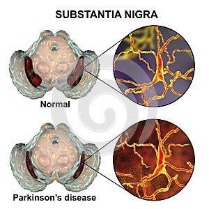 Substantia nigra in norm and in Parkinson`s disease