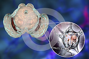 Substantia nigra in Parkinson's disease