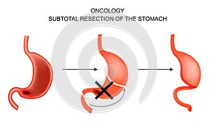 Subtotal resection of the stomach. photo