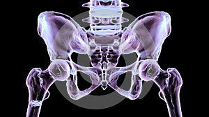 Subtrochanteric femur fracture, 3D illustration photo