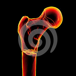 Subtrochanteric femur fracture, 3D illustration photo
