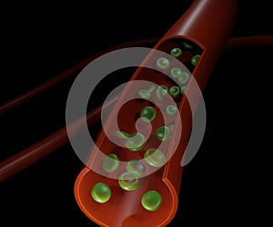 Sulfhemoglobinemia. The pigment is a greenish derivative of hemoglobin in the blood artery photo