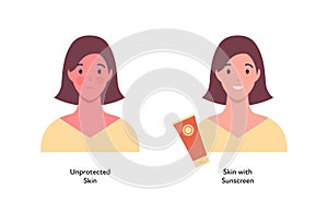 Summer skin care and sunscreen protection concept. Vector flat people illustration. Compare of woman with unprotected skin tan and