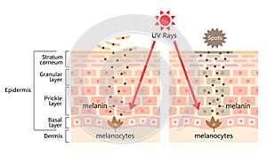 sun’s UV radiation induces dark spot by melanin. Human skin layer and cell illustration. Beauty and health care concept