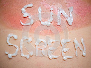 Sun screen burn