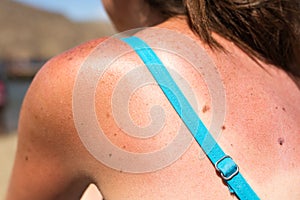 Sunburn from beach sun light on the shoulder and back of caucacian girl,woman at the vacation beach on holiday in
