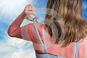 Sunburn concept. Young woman with red sunburned skin on her back photo