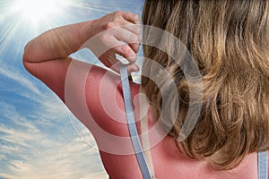 Sunburn concept. Young woman with red sunburned skin on her back photo