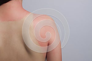 Sunburn effect on body without protect