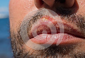 Sunburn on man lips closeup. Sun burn or bacterial infection on skin. Skin medical problem. Skin inflammation